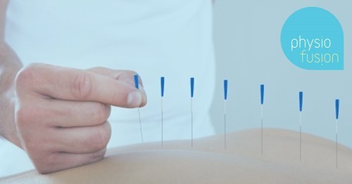 accupuncture.jpg