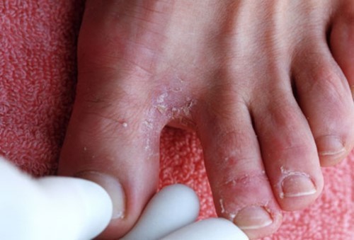 athletes-foot.jpg