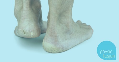 cracked-heels.jpg